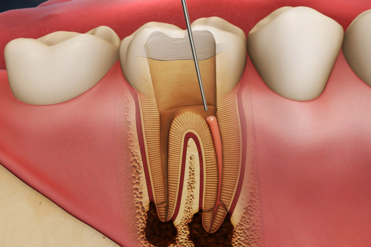 root-canal-1